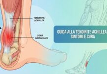 Tendinite Achillea: cos’è e perché colpisce tanti runner Tendinite Achillea